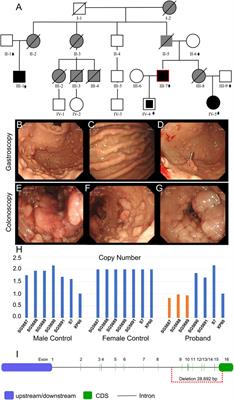 Identification of a novel CNV at the APC gene in a Chinese family with familial adenomatous polyposis